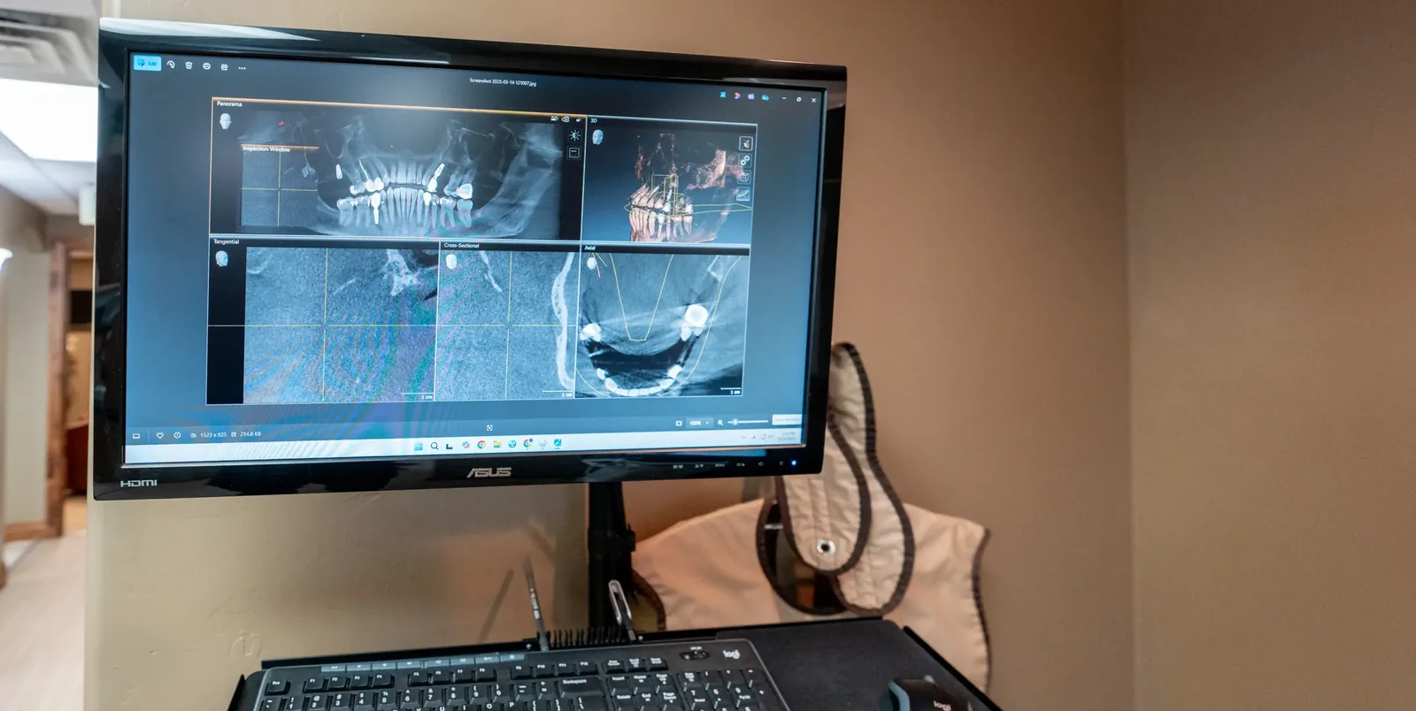 Computer monitor displaying 3D dental CBCT scans showing teeth and dental implants.